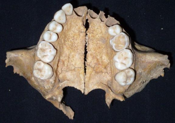 The levels of dental caries falls at the lower end of the expected range for the later medieval period (Cox and Roberts 2003: 259).