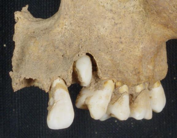 Two articulated individuals were found to have developmental dental anomalies.