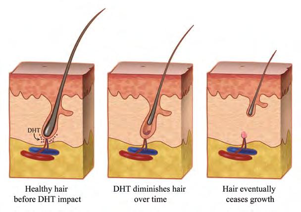 Why is my hair thinning? More than 95% of hair thinning in men is attributed to Androgenic Alopecia, also known as male pattern baldness.
