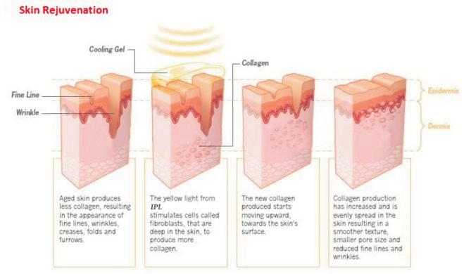 The light from SHR stimulates cells called fibroblasts, that are deep in the skin, to produce more collagen. 3.
