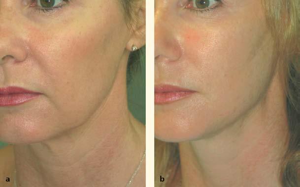 72 Non Surgical Facial Rejuvenation with the 4R Principle 645 Fig. 72.13. a Before and b immediately after Woffles Lift version 1.