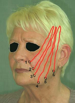 Additional threads can be inserted at yearly intervals to account for loss of effect and natural aging of the patient s face. It is not appropriate in those with thick, heavy jowls.
