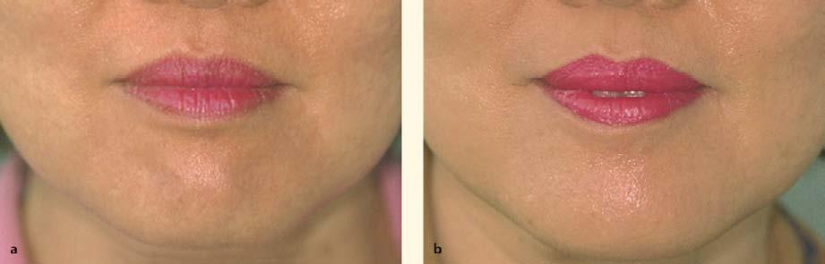 72 Non Surgical Facial Rejuvenation with the 4R Principle 641 Fig. 72.7. a Before and b after BOTOX chin rejuvenation 72.