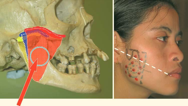 642 Fig. 72.8. Surface markings of the masseter bellies Fig. 72.9.