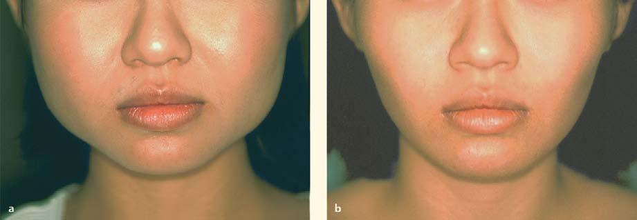 72 Non Surgical Facial Rejuvenation with the 4R Principle 643 Fig. 72.10. a Before and b 6 weeks after BOTOX facial slimming, 40 units per side third of its original volume.