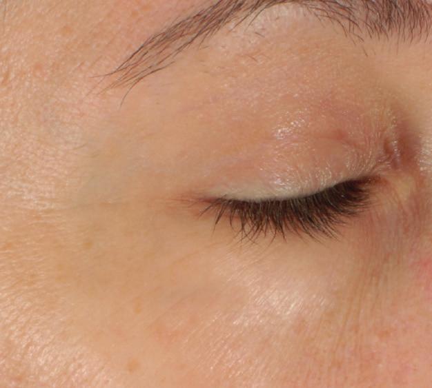 REPAIR Before After Note the diminished lines, wrinkles, discolorations and smoother texture after 8 weeks of daily treatment. Intensive Eye Therapy Item# F30012 15 g This unique SynerG Formula 6.