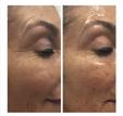 Express Dermaplaning Treatment & CooLifting Combination $200 (reg $275) Murad Invisiblur primes, blurs imperfections, and protects