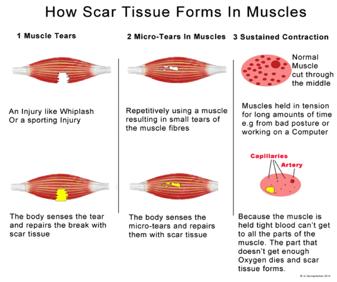 Our body produces fibrous scar tissue over the damaged area while the muscle repairs itself. These fibers do not go in a nice, straight pattern like healthy tissue and this is what feels like knots.