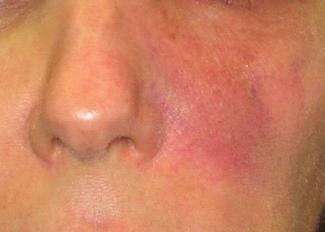 Clearing Up Problem Spots. Untreated acne scars (1). Following three treatments with the lunchtime laser (2).
