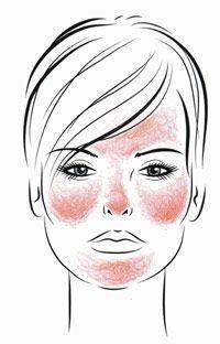 WHAT IS ROSACEA?