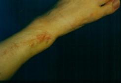 Of course we know that grafted skin and adhered scar tissue are especially susceptible to rubbing.