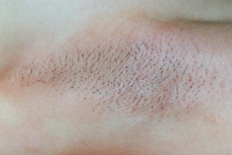 Skin reaction directly after treatment (end-point)