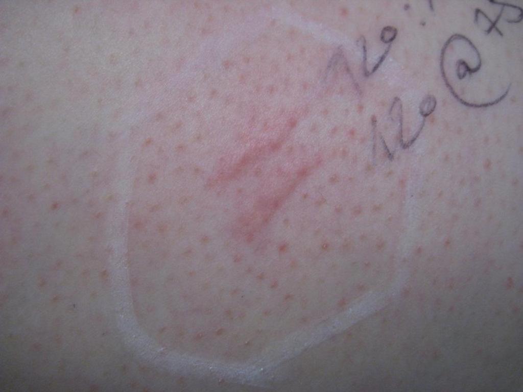 Skin reaction directly after treatment