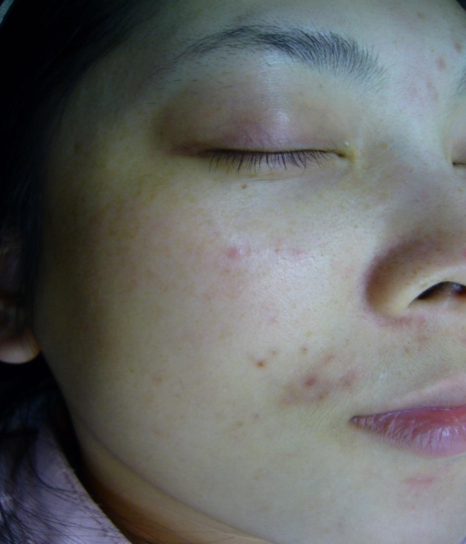 Clinical Results Acne vulgaris - before and 2 weeks