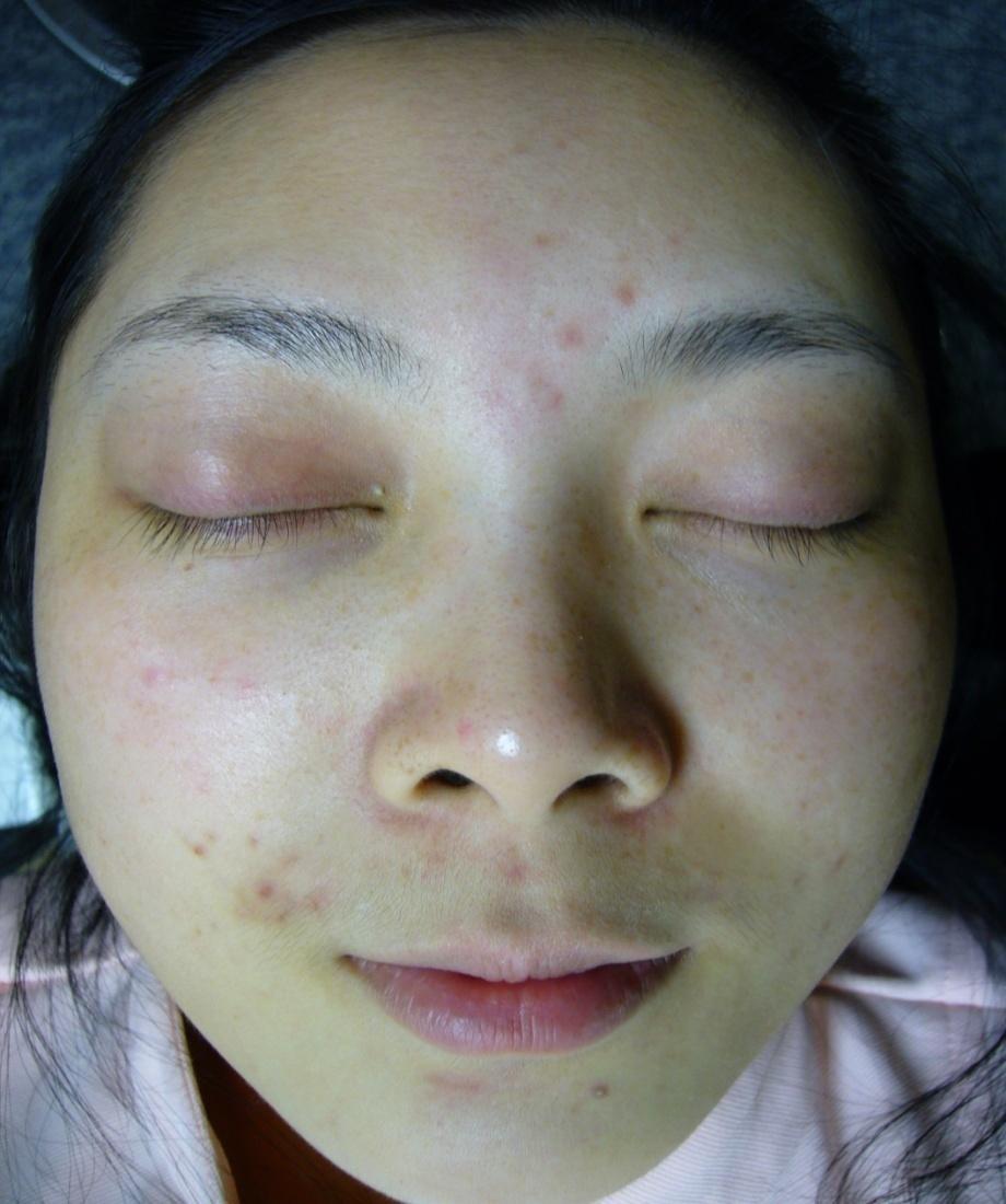 Clinical Results Acne