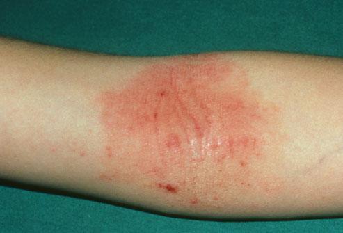 Atopic Dermatits (Eczema) An itchy inflammation of the skin Eczema is very common, with