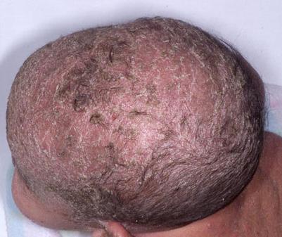 Seborrheic Dermatitis A skin condition that causes scaly patches and red skin, mainly on the scalp.