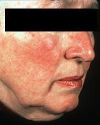 Acne Rosacea A condition that causes redness and often small, red,