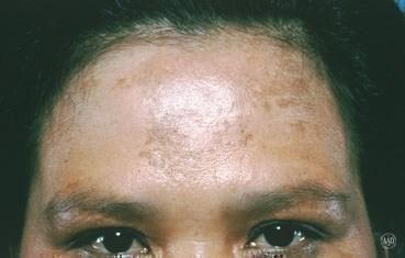 Melasma This skin condition causes brown to gray-brown patches.