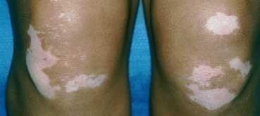 Vitiligo Skin loses its natural color, causing patches