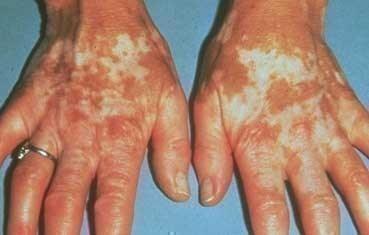 It is common to have vitiligo occur on the hands, but