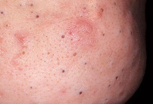 red and tender bumps. This condition can be treated with overthe-counter creams and cleansers.