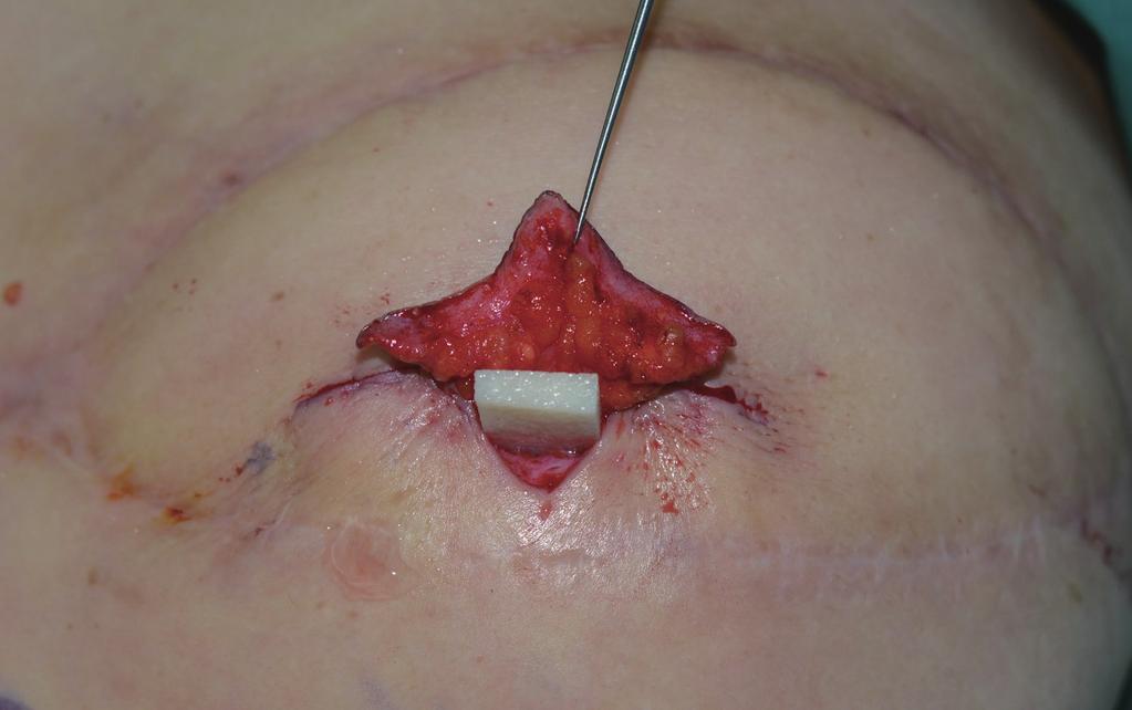 () piece of 1 2 cm MegaDerm is trimmed into an O shape for insertion and fixed with 5-0 Vicryl as the O-strut transversely beneath the wrapped bilateral flaps in cases following LD flap