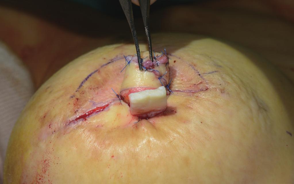 (D) MegaDerm is inserted as the L-strut from the space between the lateral wings to the space beneath the new nipple following expander/implant breast reconstruction.