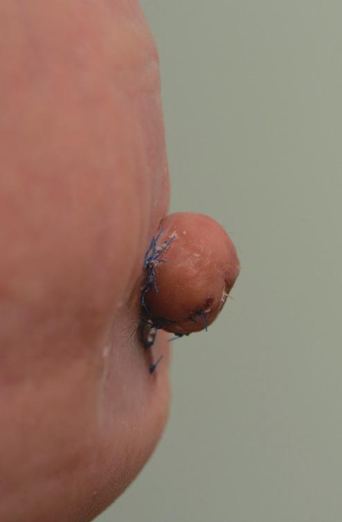 Clinical photos in a tissue expander/implant patient lateral view of a 59-year-old female breast demonstrating nipple projection of 1.5 cm immediate postoperatively () and 1.