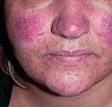 Because of its red-faced, acne-like effect, it is often untreated or treated with the wrong products.