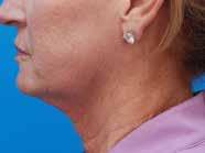 improvement in skin laxity compared to a surgical face lift 4 Natural healing