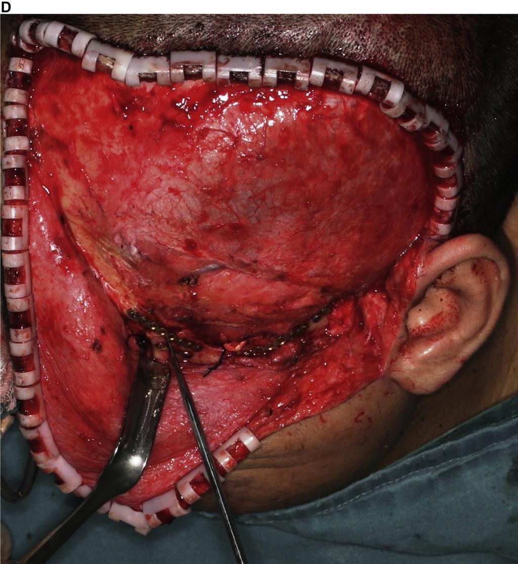 2110 ZYGOMATIC SURFACE MARKER-ASSISTED SURGICAL NAVIGATION FIGURE 4 (cont d). D, Location of the segment guided by plan 2. to address the challenges of this type of injury.