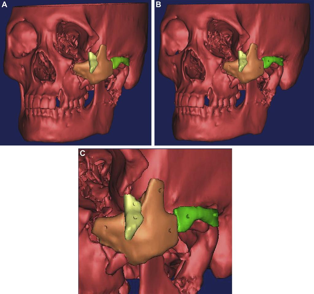 HE ET AL 2103 FIGURE 2. Surgical planning. A, 3-Dimensional reconstruction and segmentation. B, Surface marker creation and location. C, Local amplification of surface marker creation and location.