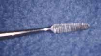 Curettes are ideal for use around the edges of the big toe nail (Figure 10). A double-ended curette, which has a 0.06 inch (1.5 mm) diameter on one end and a 0.1 inch (2.