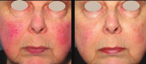 A trusted path to superior outcomes Before After Rosacea