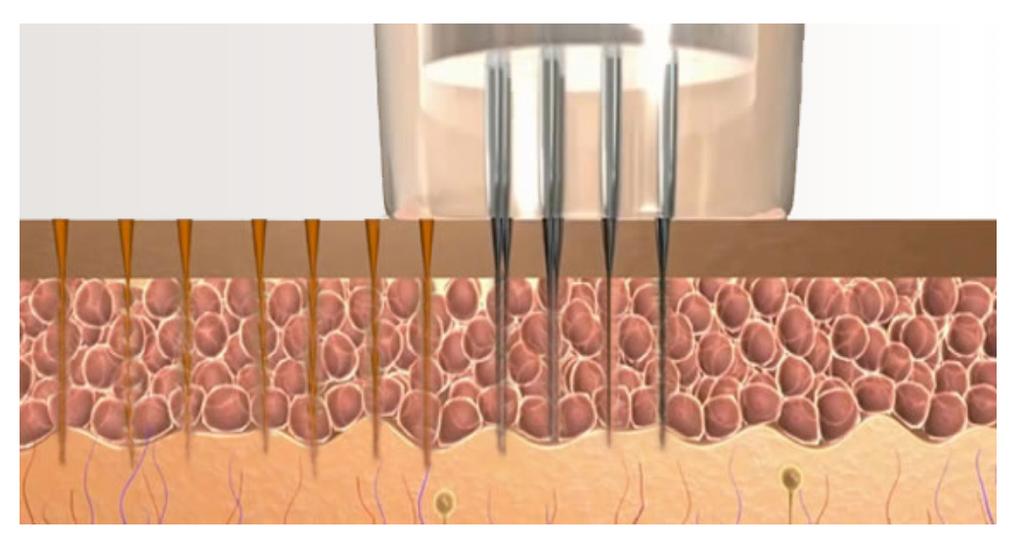 to 2.5mm. Minimal skin perforations stimulate the production of new collagen and elastin.