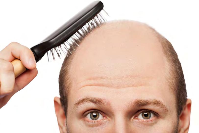 Dihydrotestosterone (DHT) Lastly, the androgen hormone called dihydrotestosterone (DHT) is known to be the most common reason for male pattern hair loss.
