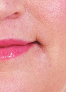 2 ml) Vertical lip lines Individual results may vary. Models were paid for their appearance.