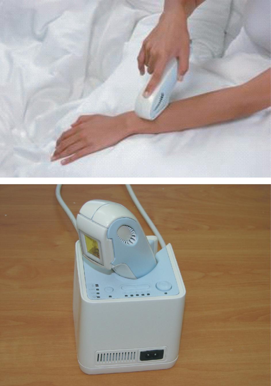 Silk n A novel device for hair removal at home 107 ranges between 50% and 75% reduction after a series of treatments (6 8). The disadvantages of in-office-based laser/light hair removal include: 1.