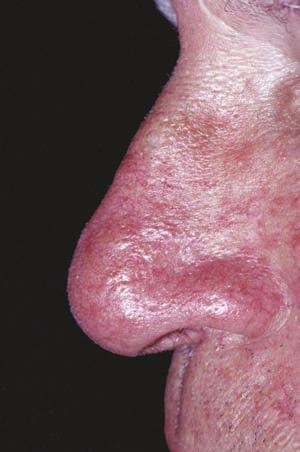 Mild swelling (edema) and redness may occur.