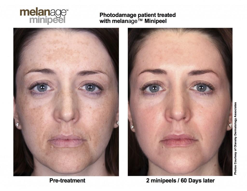 Managing your discomfort: Deep chemical facial peels will result in peeling, redness and discomfort for