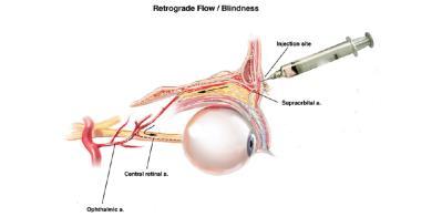 Slide 28 Locations of Iatrogenic Retinal Artery Occlusion Glabella (50%) Nose (33%) Forehead (8%) Periorbital (8%) Parks SW.
