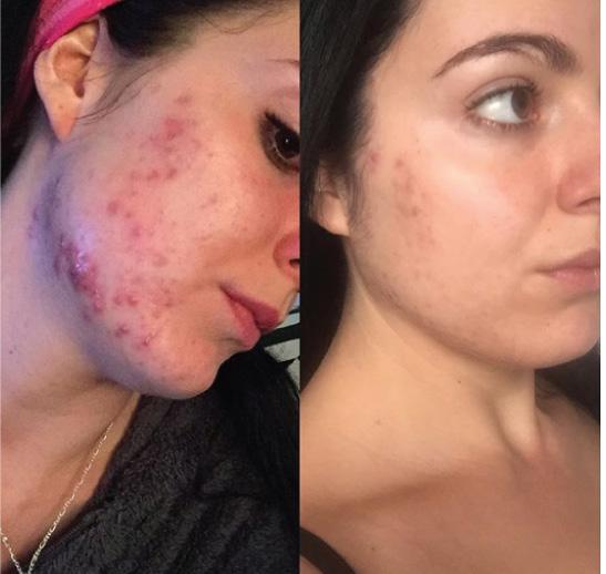 3 It s the kind of skincare your skin has been searching for its whole life! Stephanie came to me with problematic acne. Her journey began a little over 5 months ago.
