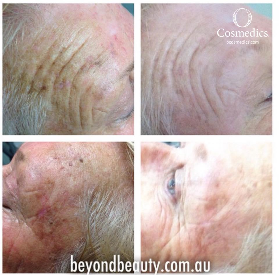 9 Amazing results from one of our clients. After just 6 weeks of using O Cosmedics Corrective Cleanser & Peel, Mineral Pro SPF 30+ and in salon LED treatments twice a week.