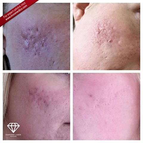 Microdermabrasion) and B3 Plus infused Skin-Needling treatments. 25-May-2015 13 Hives and Rosacea. People say be gentle, don t use anything active and we say kick that rosacea to the curb!