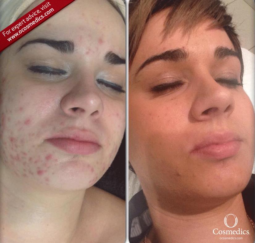 Great result delivered by the O Skin Experts at Cocobelle beauty salon!