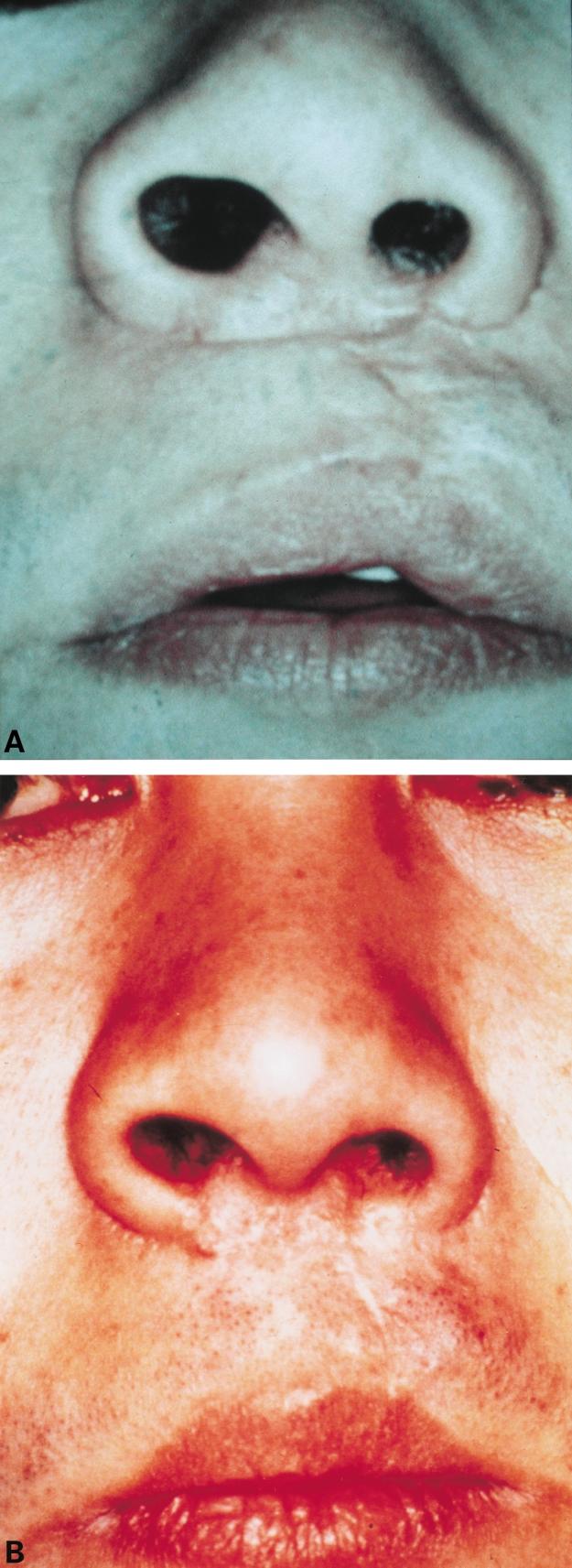 Surgical creation of a Cupid s bow using W-plasty in patients after cleft lip surgery 377 Fig.