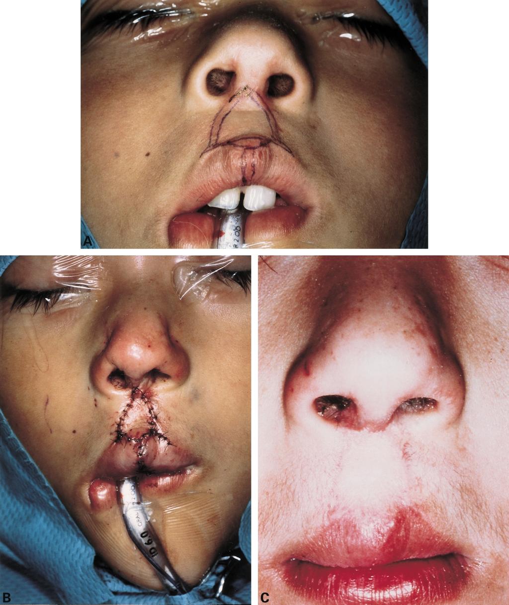 378 A. Takeshita et al. Fig. 8 Pre-operative design (A) and the appearance immediately after surgery (B). This indicates the appearance at 6 months after surgery (C).