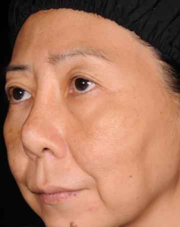 wrinkles Glabellar wrinkles Upper lip wrinkles Evaluation of