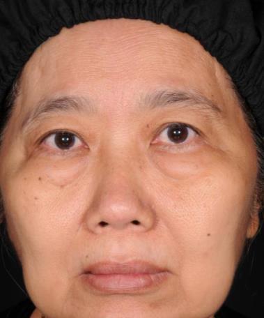 cheeks Face contour sagging Ptosis of the lower part of the